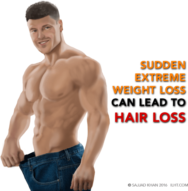 Diagnosis of Hair Loss in Men - ILHT Dubai Diagnosis of Hair Loss in Men - ILHT Dubai