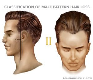 Classification of Male Pattern Hair Loss - ILHT Dubai