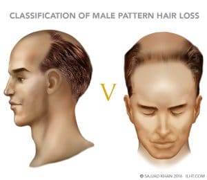 Classification of Male Pattern Hair Loss - ILHT Dubai Classification of Male Pattern Hair Loss - ILHT Dubai