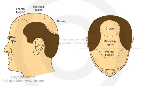 bald-scalp-regions