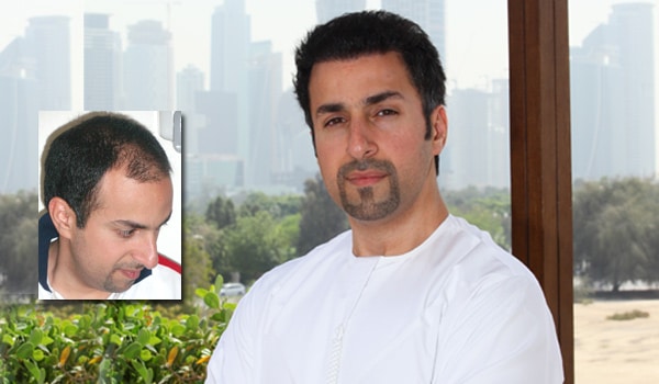hair transplants results