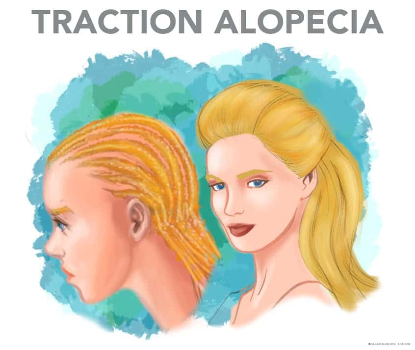 Traction-Alopecia-treatment