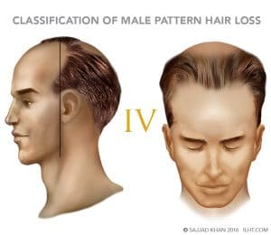 Classification Of Male Pattern Hair Loss Ilht Dubai