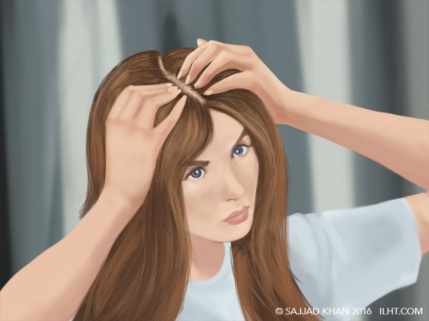 Women Hair Loss Ilht Dubai